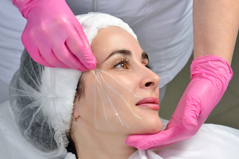 Anti Aging Thread Lift Face Neck Jawline
