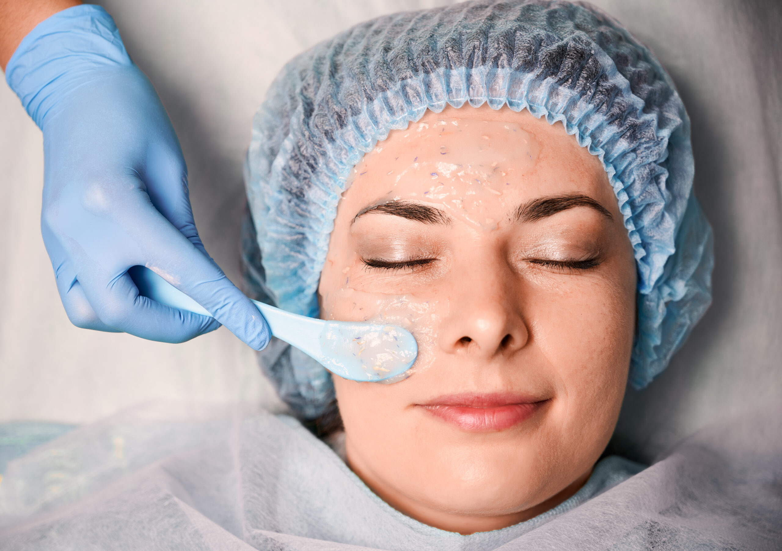 Chemical peel treatment in Jayanagar